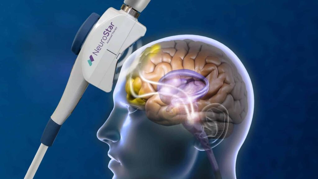 transcranial magnetic stimulation revolutionizes depression treatment aiding mental health